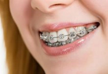 Photo of فوائد وأضرار تقويم الأسنان وما يجب عليك معرفته قبل وضعه