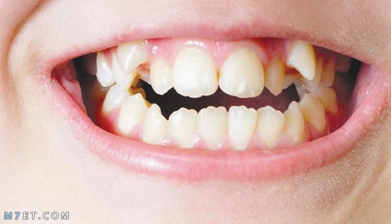 كيف يعمل تقويم الأسنان و طريقه تركيبه