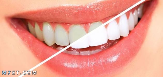 طرق جديدة لتبييض الأسنان