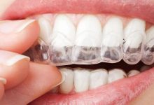 Photo of طريقة لتبييض الاسنان في يوم واحد