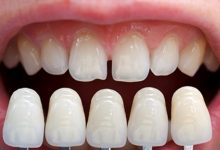 Photo of طريقة تلبيس الأسنان
