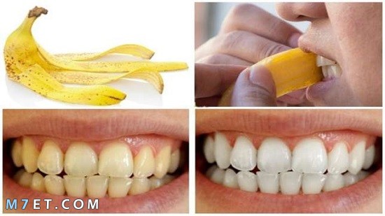 فوائد قشر الموز لتبييض الاسنان