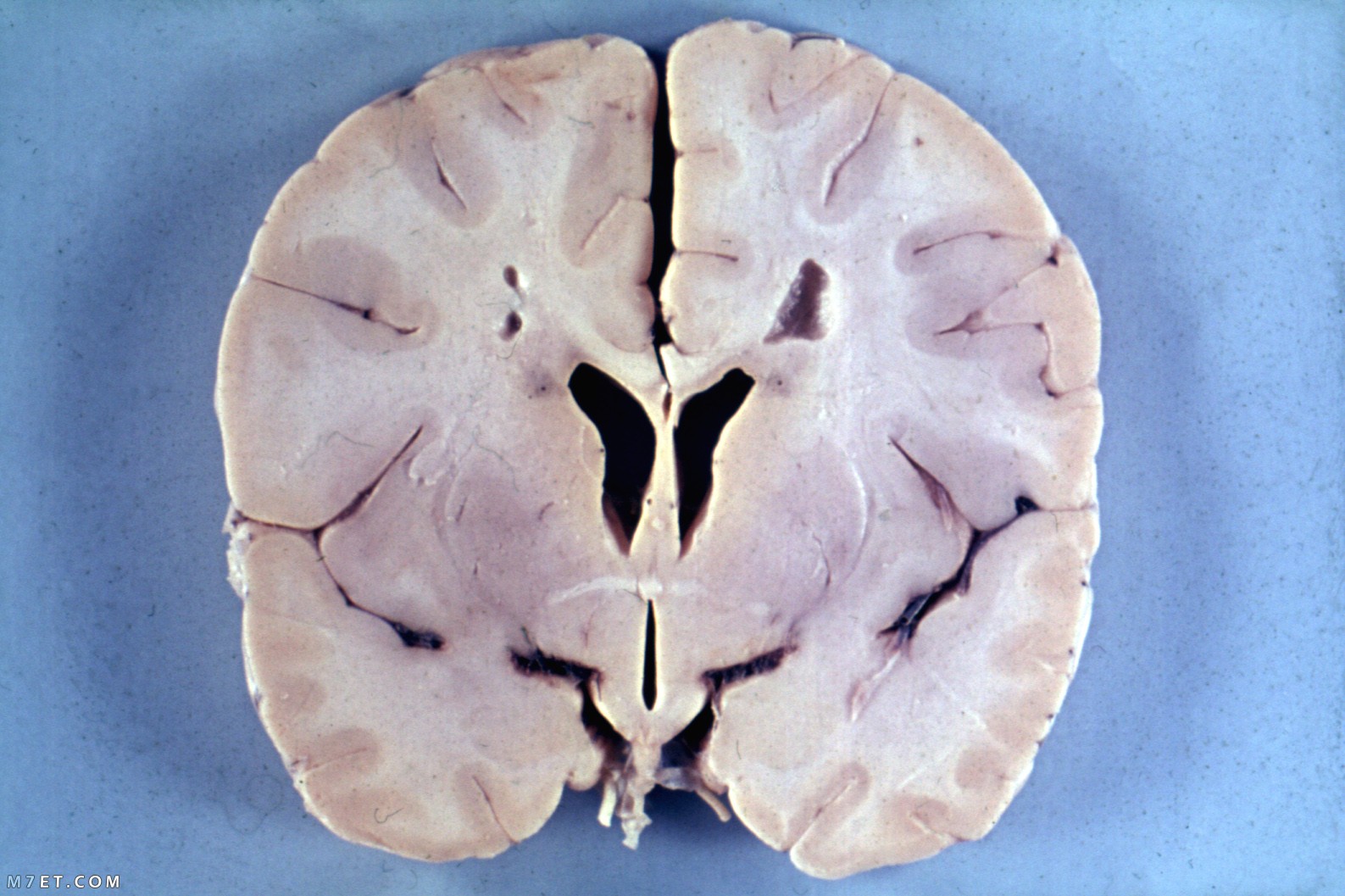 أعراض التهاب الدماغ الحاد المنتشر