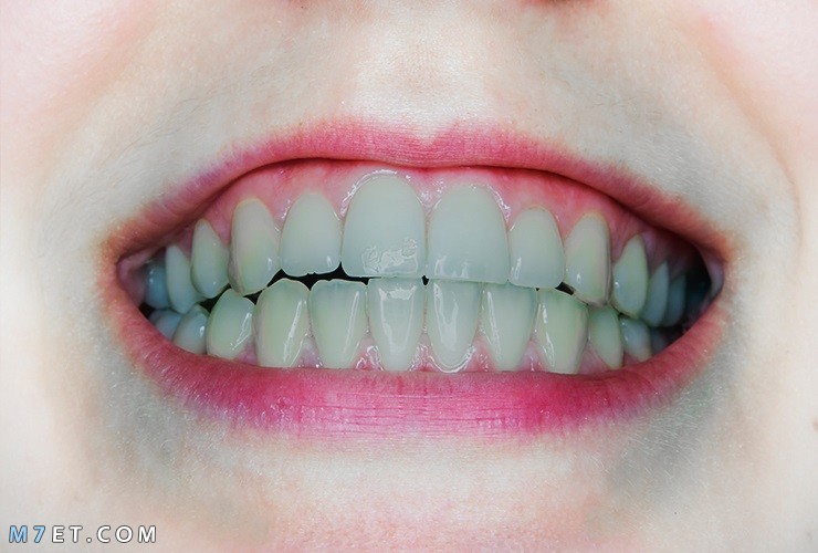 أسباب تغيّر لون الأسنان