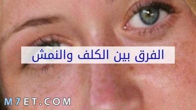 Photo of الفرق بين الكلف والنمش والشامة والرؤوس السوداء