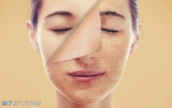 علاج تصبغات الوجه بالليزر