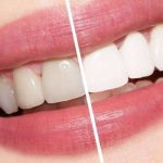 اضرار تبييض الاسنان وأهم النصائح لتجنب حدوثها