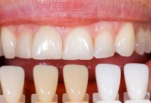 Photo of أسباب تغيّر لون الأسنان إلى اللون الرمادي والشفاف