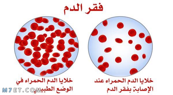 مرض الانيميا ماهو فقر الدم: