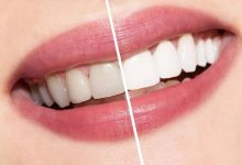 Photo of كيفية جعل الاسنان بيضاء بالخلطات الطبيعية