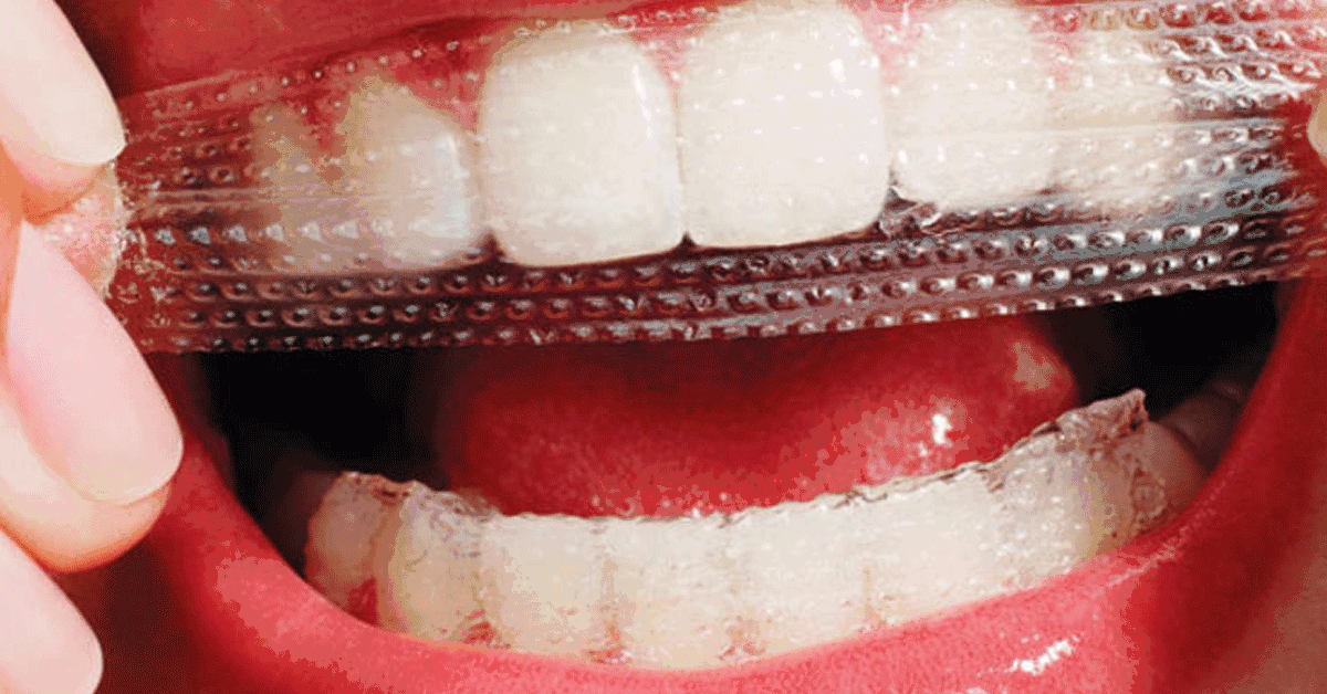 أضرار لصقات تبييض الأسنان