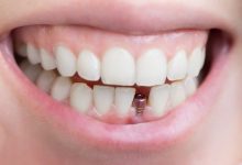 Photo of أنواع تركيبات الأسنان المتنوعة 2023