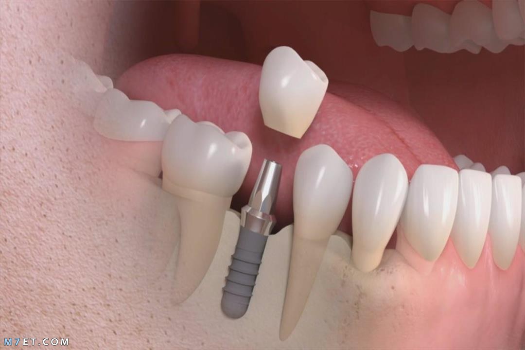 الفرق بين تركيبات الأسنان الحديثة والقديمة
