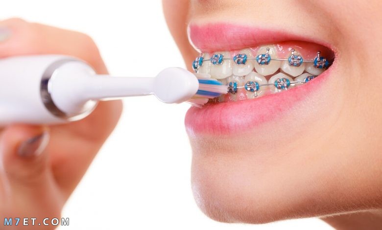 كيفية تنظيف الاسنان مع التقويم