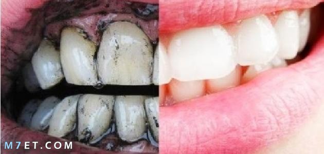 افضل طريقة لتبيض الاسنان