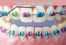 Photo of كيفية العناية بتقويم الاسنان