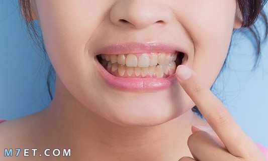 كيفية العناية بتقويم الاسنان