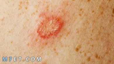 Photo of أمراض الجلد الفطرية أعراضها وطرق علاجها بالتفصيل