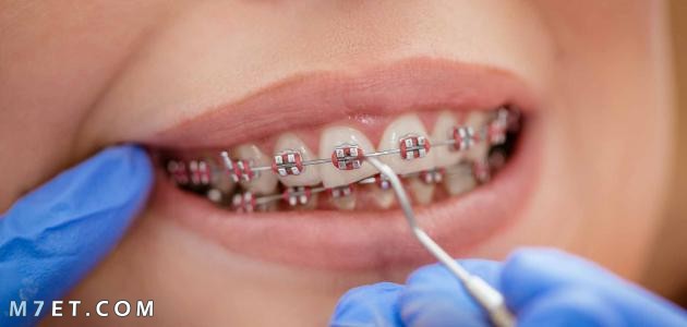 انواع تقويم الاسنان وافضله