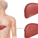 التهاب الكبد | أنواع التهاب الكبد واعراضها