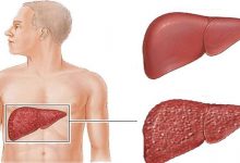 Photo of التهاب الكبد | أنواع التهاب الكبد واعراضها