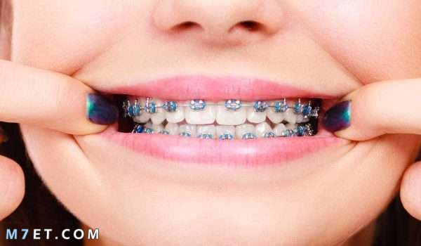 كيفية ازالة تقويم الاسنان