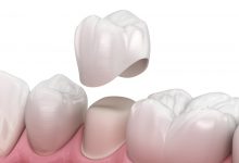 Photo of تلبيس الاسنان المؤقت | 7 أنواع من تلبيسات الأسنان