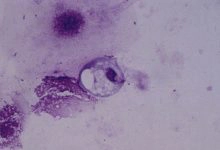Photo of أنواع التريكوموناس وطرق علاج داء المشعرات