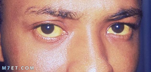 علاج اصفرار العين الغير مرضى