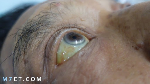 علاج اصفرار العين الغير مرضى