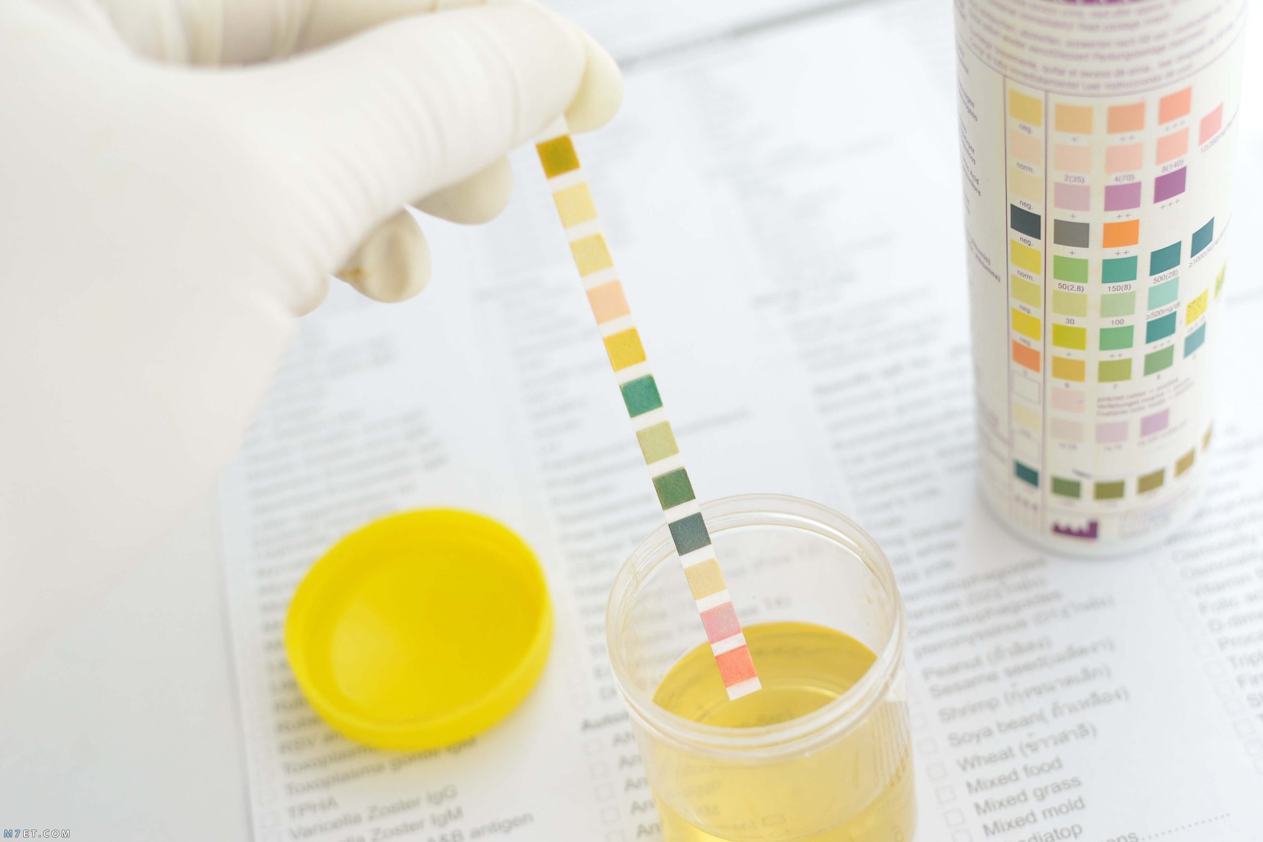 تحليل urine analysis