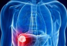 Photo of دهون الكبد | ما هي أعراضها وكيفية العلاج منها وعوامل خطر الإصابة بها