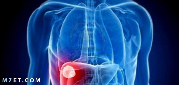 دهون الكبد | ما هي أعراضها وكيفية العلاج منها وعوامل خطر الإصابة بها 2022