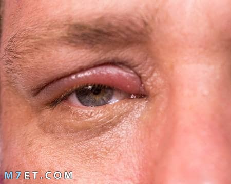 علاج التهاب جفن العين العلوي بالأعشاب