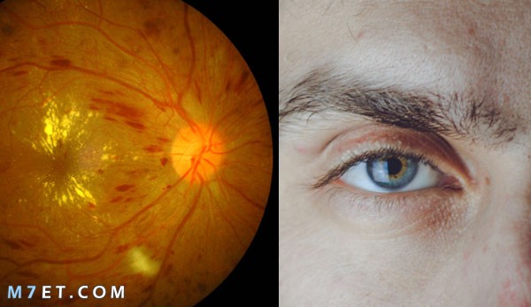 اعراض ارتشاح قاع العين