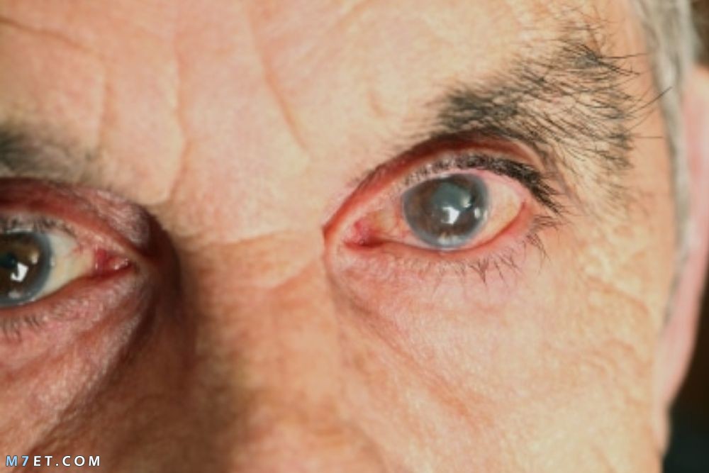 اعراض ارتشاح قاع العين