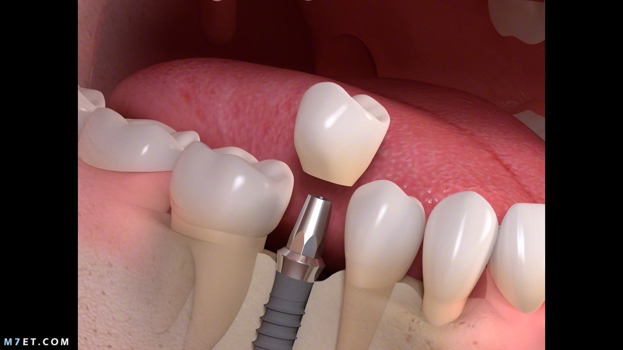 مراحل زراعة الاسنان      