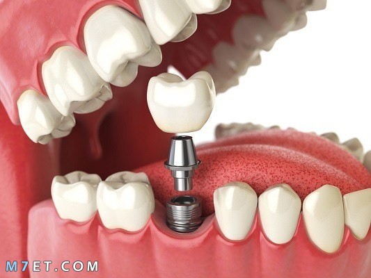 مراحل زراعة الاسنان      