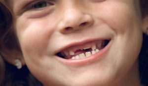 استبدال الأسنان عند الأطفال