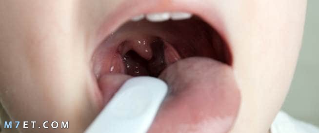 التهاب الحلق عند الأطفال المصابين باللوزتين