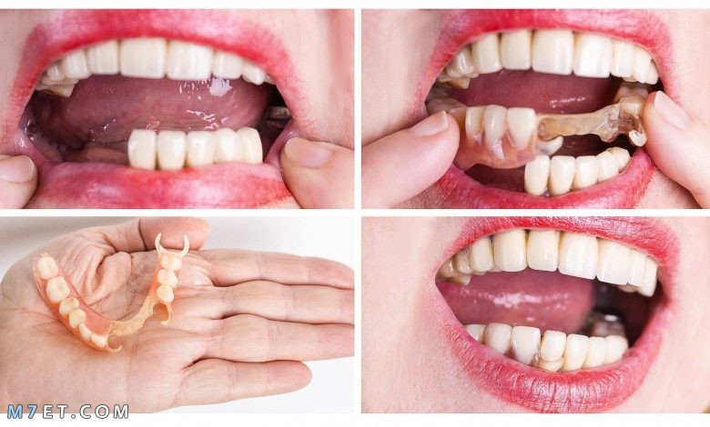 تركيب الأسنان الأمامية