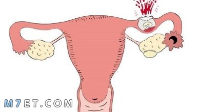 Photo of أعراض الحمل خارج الرحم