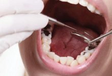Photo of كيف أزيل تسوس الأسنان بدون طبيب بالطرق الطبيعية