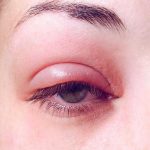 علاج انتفاخ جفن العين العلوي