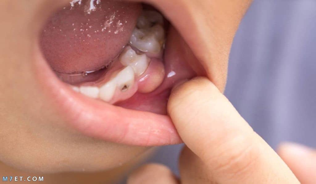 تجارب علاج خراج الأسنان