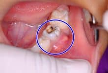 Photo of تجارب علاج خراج الأسنان