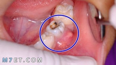 Photo of تجارب علاج خراج الأسنان