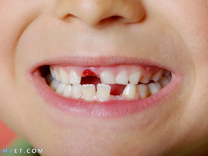 مشاكل تبديل الأسنان عند الأطفال