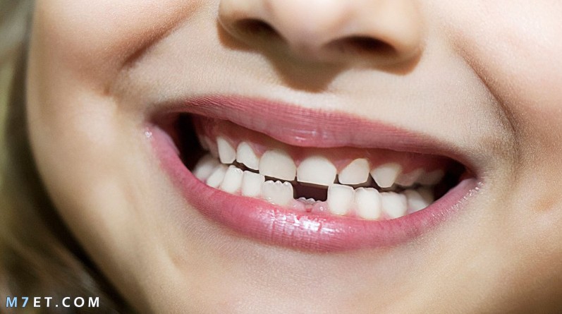  مشاكل تبديل الأسنان عند الأطفال