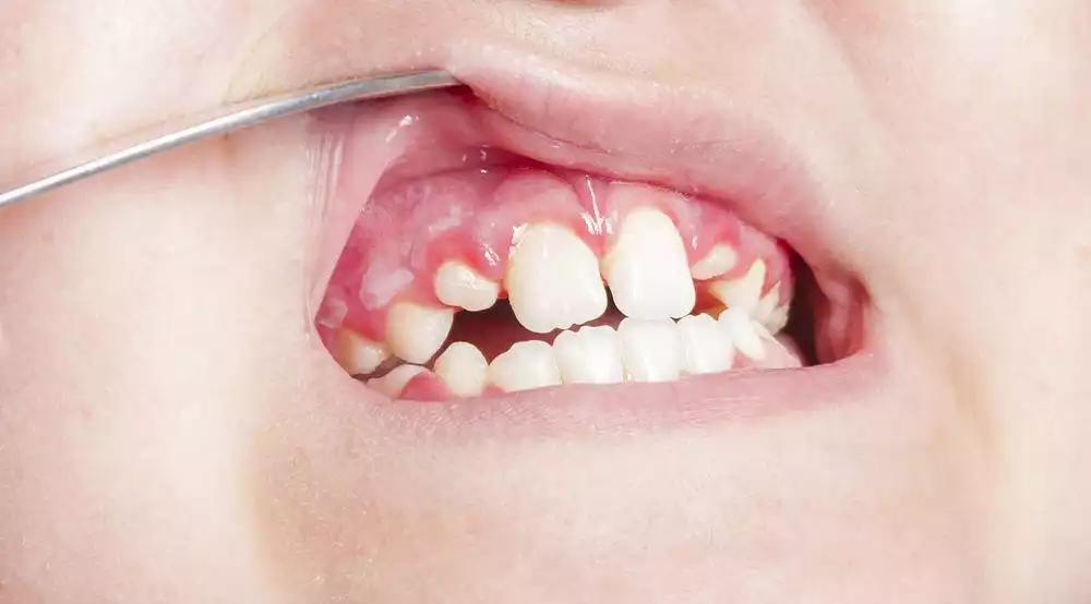 أعراض تبديل الأسنان عند الأطفال